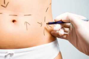 Plastic Surgery Beyond Borders in Mexico